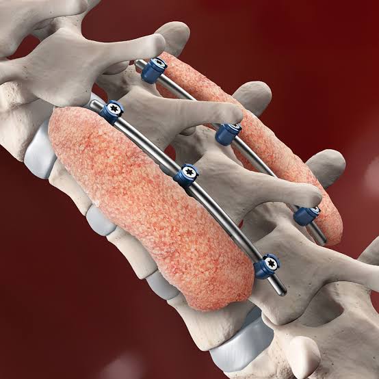 Spine surgery consultation